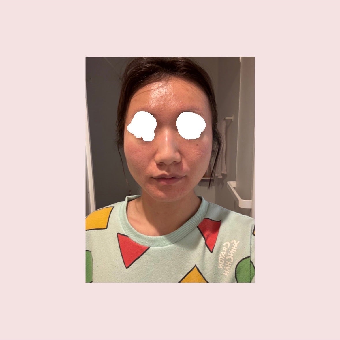 お芋ちゃん|10年以上ニキビに悩む保育士 on LIPS 「投稿するのを迷うくらい見られるのが嫌だったのですが、経過をまた..」(5枚目)