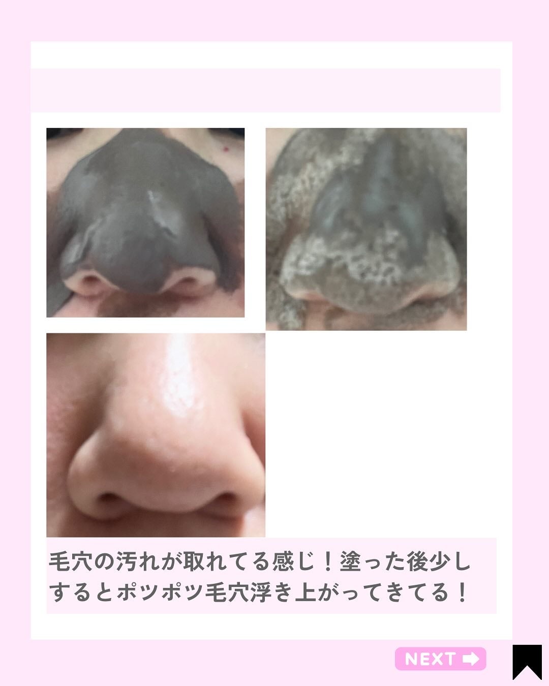 ツルリ 皮脂吸い出し 部分用パック ガスール&レッドパワー/ツルリ/洗い流すパック・マスクを使ったクチコミ(6枚目)