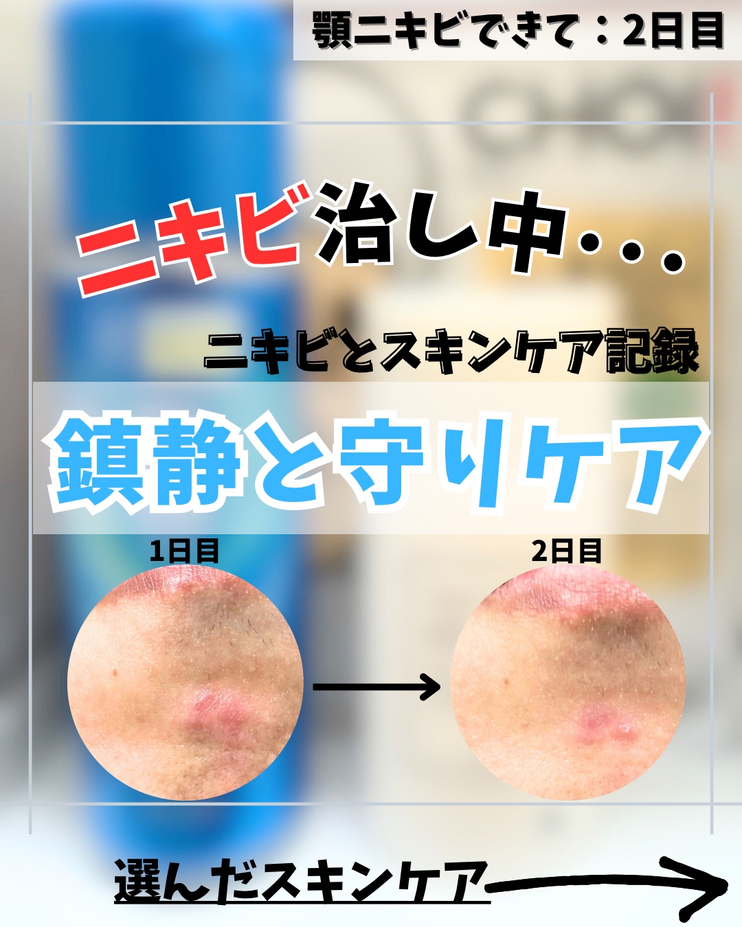 CHOI薬用マスク ニキビケア ［医薬部外品］/肌美精/シートマスク・パックを使ったクチコミ（1枚目）