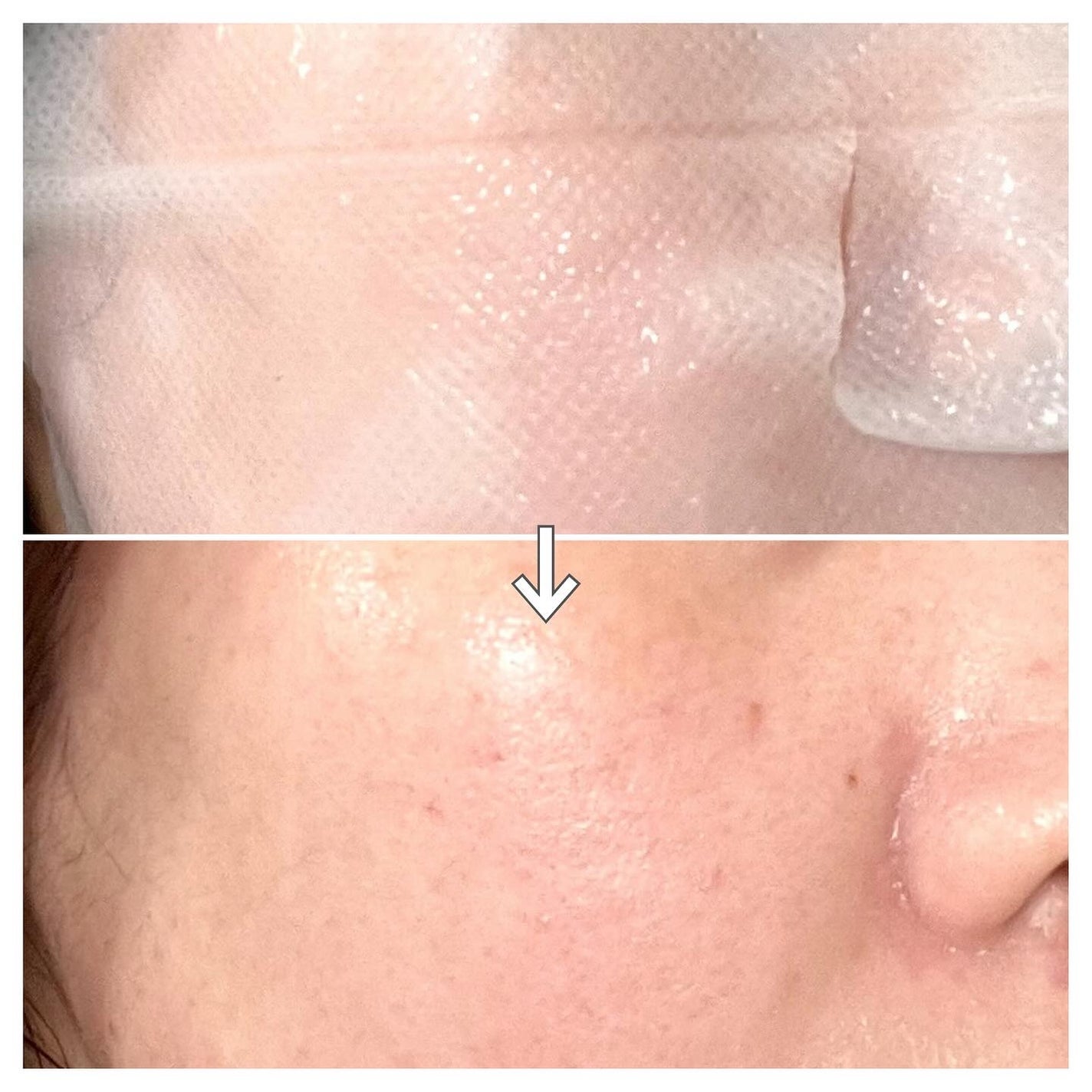 EXOGAR traser premium マスクパック/VEMONTES/シートマスク・パックを使ったクチコミ(5枚目)