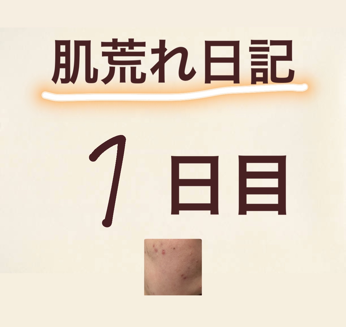 肌荒れ日記はじめます！！







最近、ニキビと乾燥がひどい、、

2枚目の画像は閲覧注意です💦


そこで、肌荒れ日記をはじめることにしました！

毎日、朝夜使ったものとその日の肌の状態を記していこうと思います😊

一緒にスキン