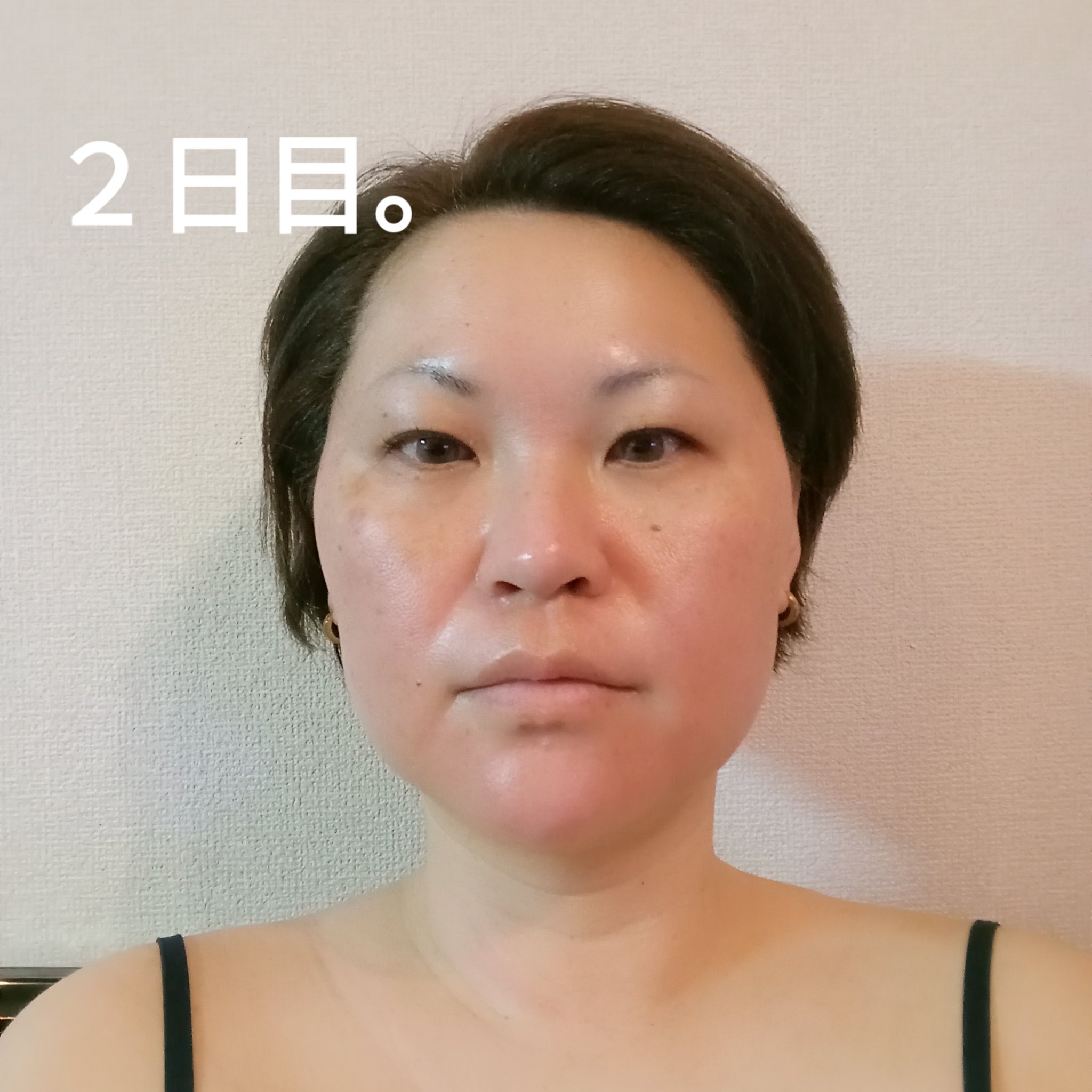 ヴァンパイアフェイシャル/セシリアクリニック/その他を使ったクチコミ（3枚目）