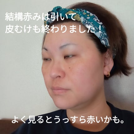 ビヨンセ奥二重向上委員長🥸LIPSパートナー🥳 on LIPS 「セシリアクリニックさんでヴァンパイアフェイシャルを受けた経過だ..」(7枚目)