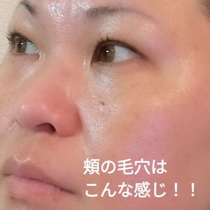 ビヨンセ奥二重向上委員長🥸LIPSパートナー🥳 on LIPS 「セシリアクリニックさんでヴァンパイアフェイシャルを受けた経過だ..」(10枚目)