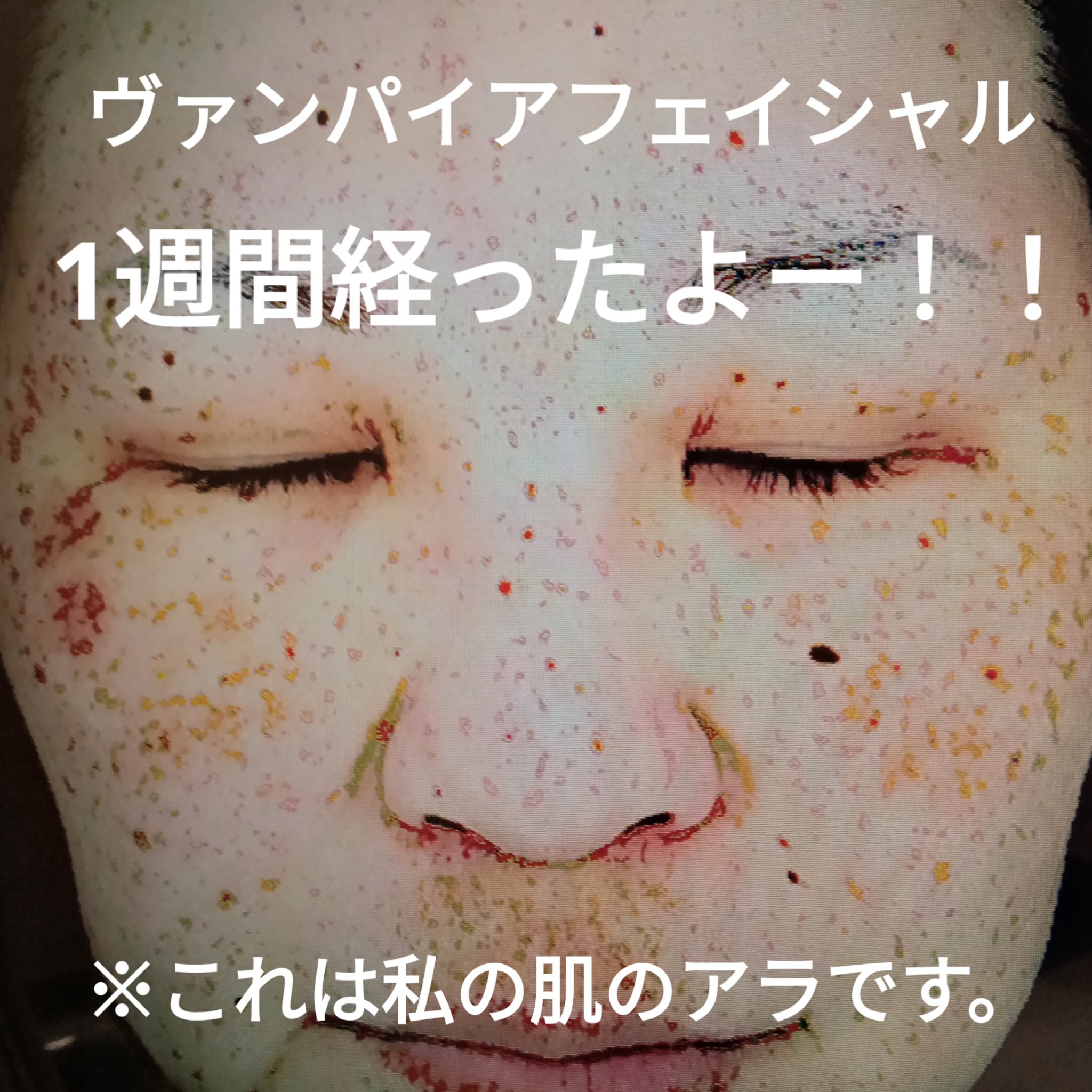 ヴァンパイアフェイシャル/セシリアクリニック/その他を使ったクチコミ（1枚目）