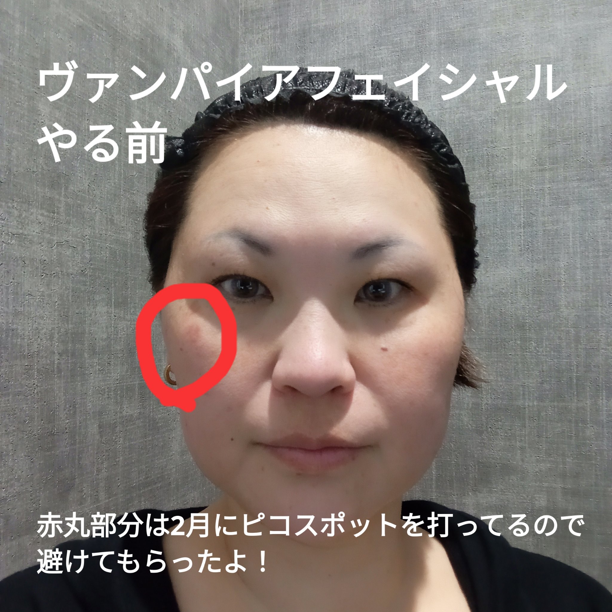 ヴァンパイアフェイシャル/セシリアクリニック/その他を使ったクチコミ（2枚目）