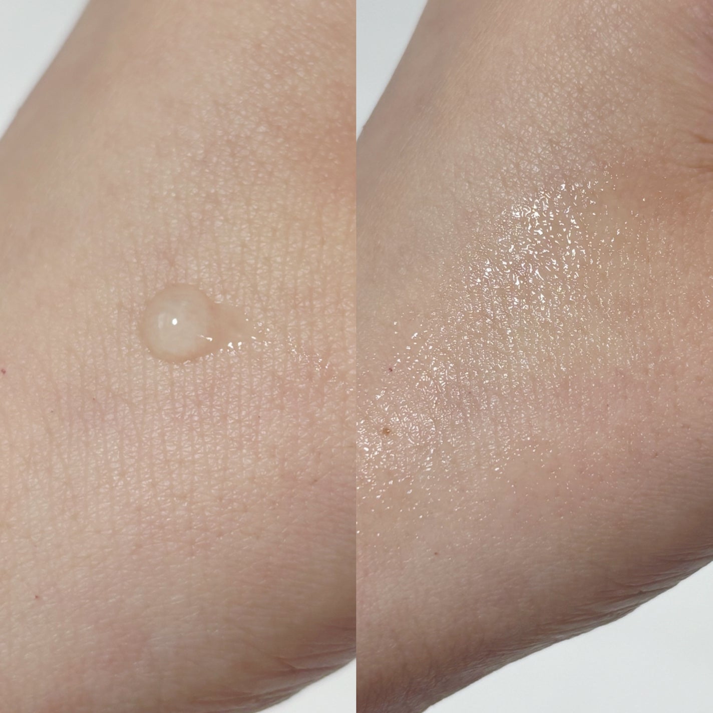 アクリンゲル/東亜製薬/その他スキンケアを使ったクチコミ(2枚目)