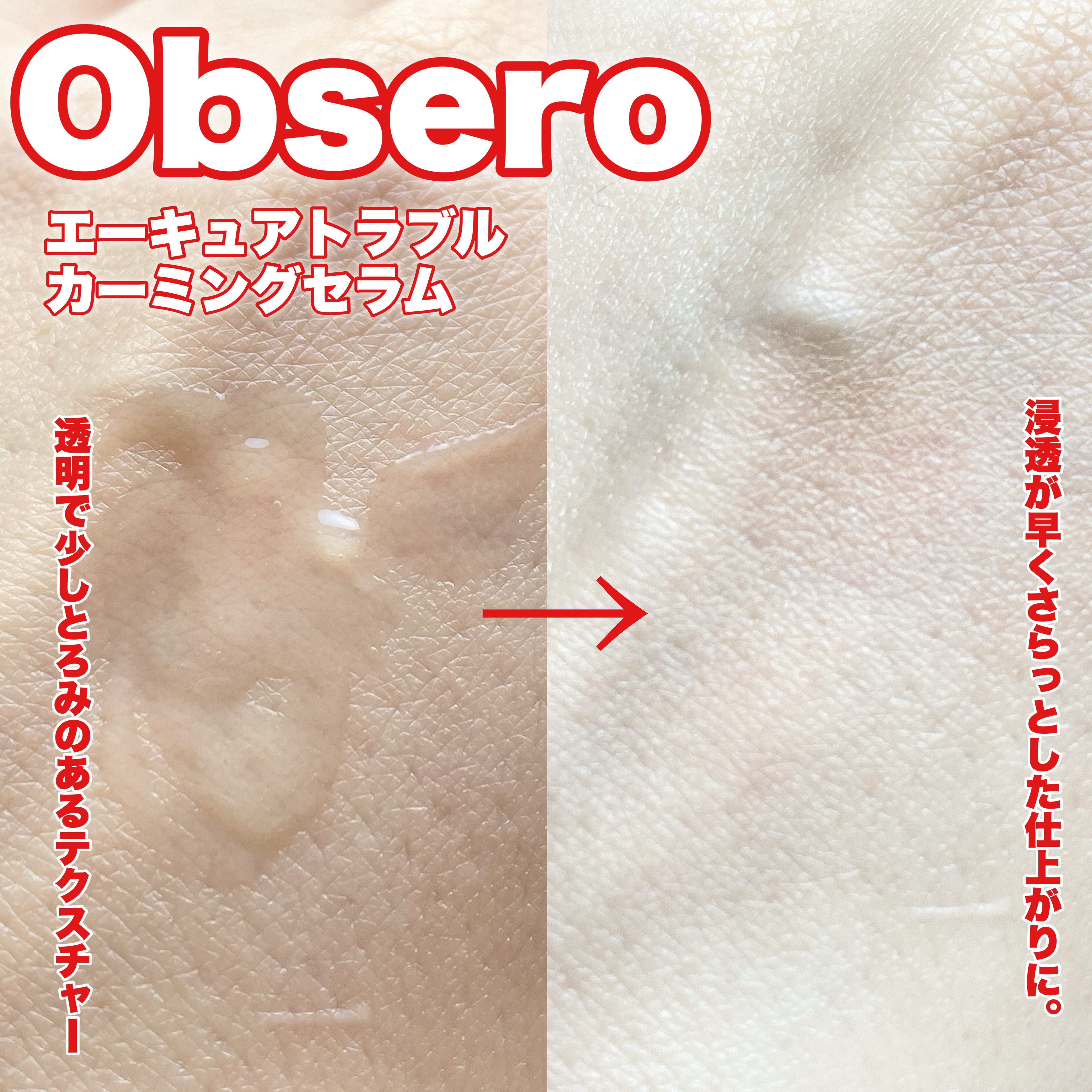 エーキュアトラブルカーミングセラム/obsero/美容液を使ったクチコミ（3枚目）
