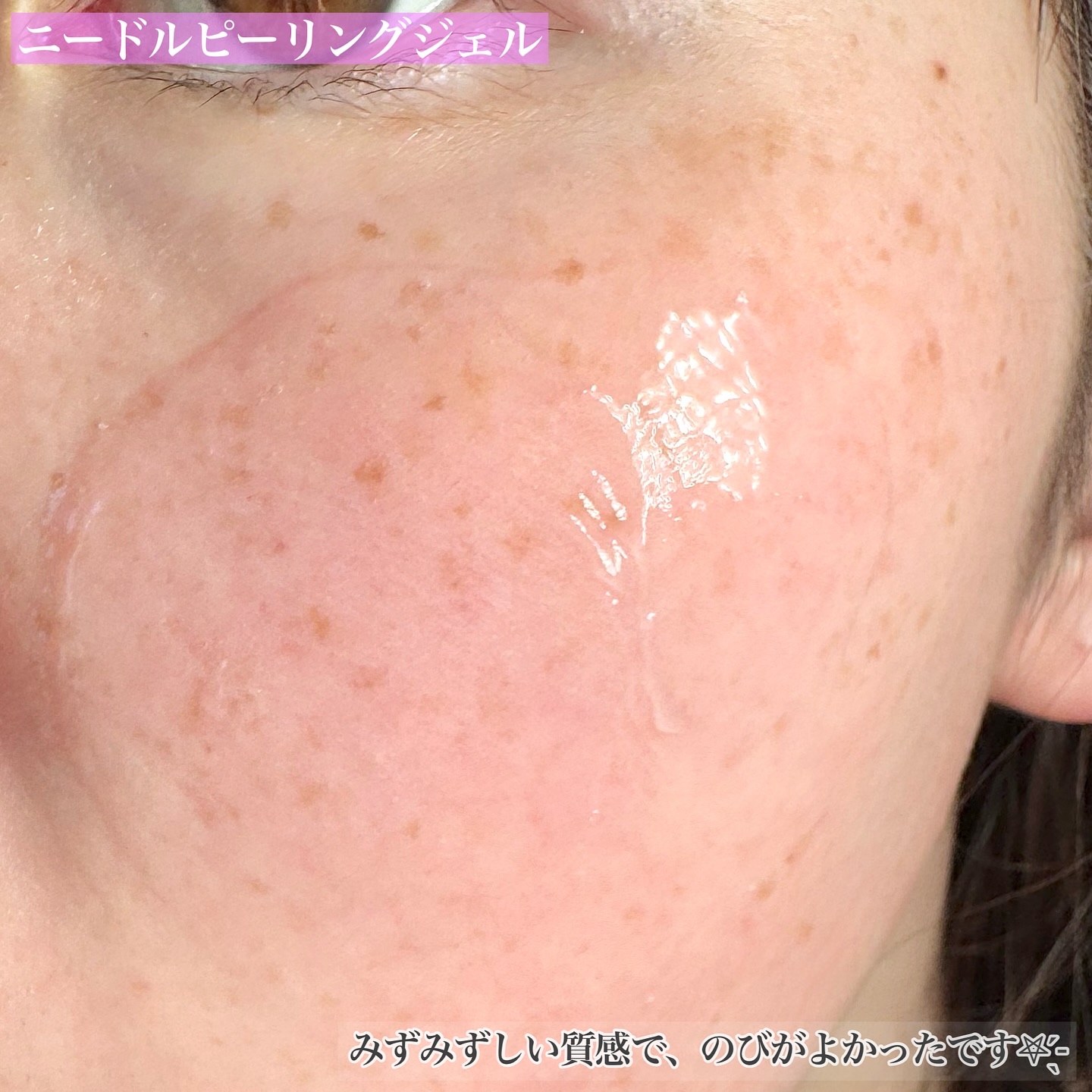 ニードルピーリングジェル/fractionalCC/ピーリングを使ったクチコミ（3枚目）