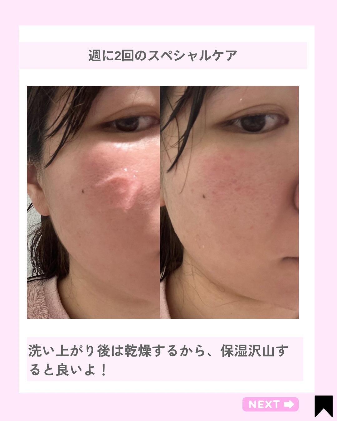 Kana on LIPS 「スピキュールピーリング?新感覚毛穴ケア!@kana.cosme..」(5枚目)