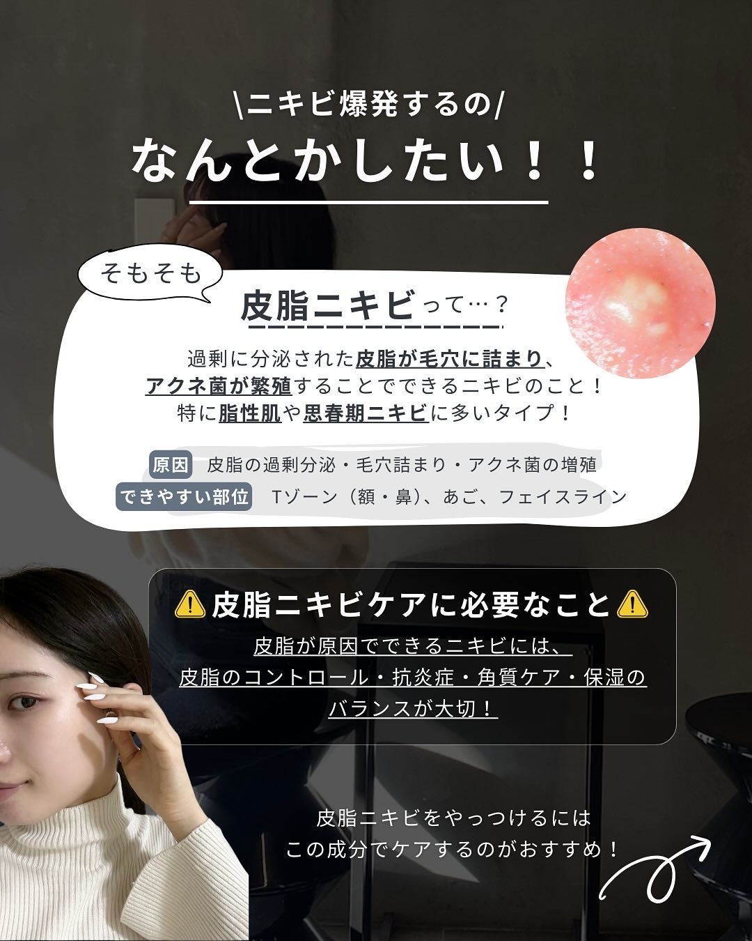 白湯(サユ) | ニキビと戦うOL🤍 on LIPS 「.白湯です!皮脂ニキビに悩む人一旦集合💫そもそも皮脂ニキビって..」(2枚目)