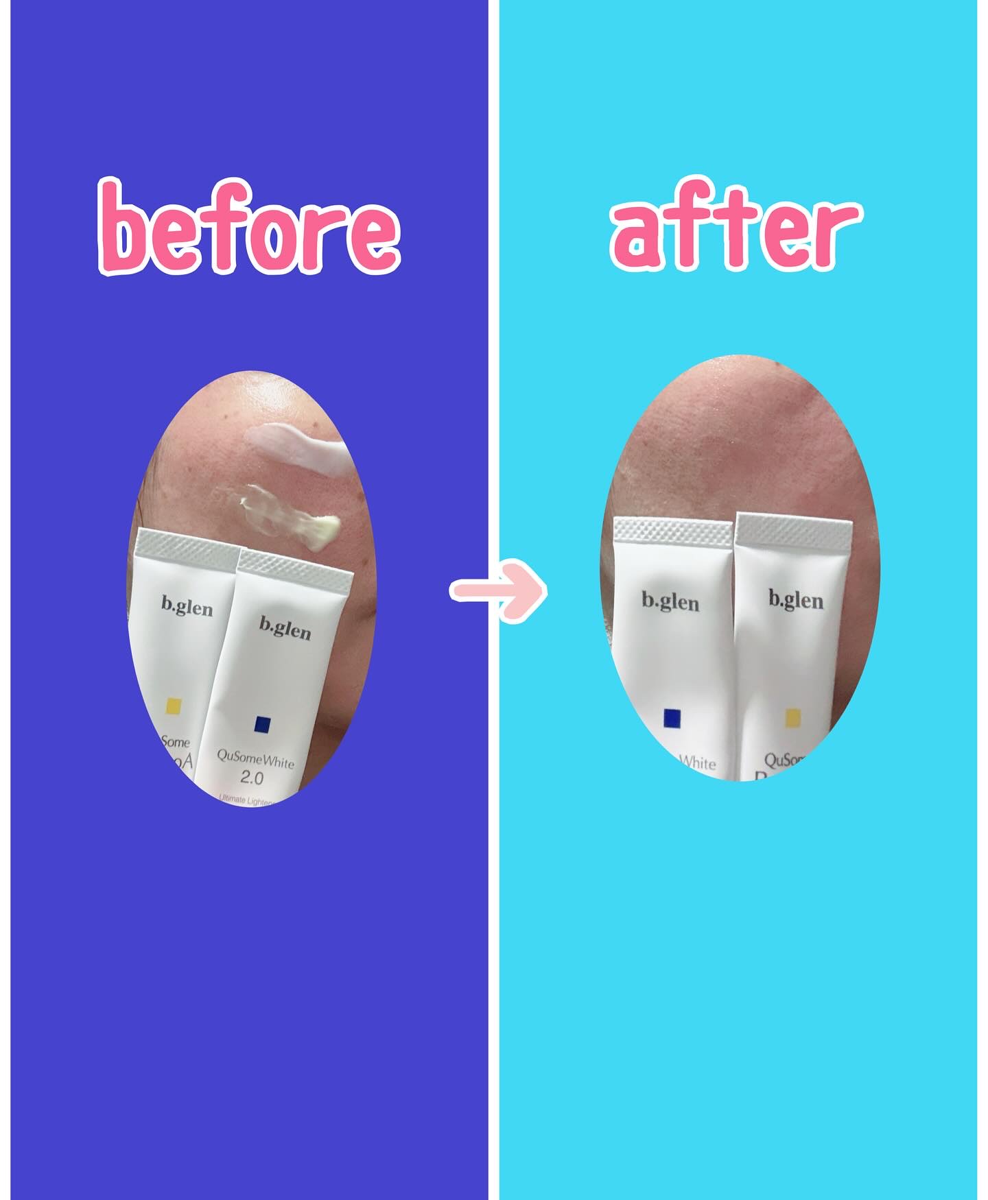 QuSomeレチノA/b.glen/美容液を使ったクチコミ（2枚目）