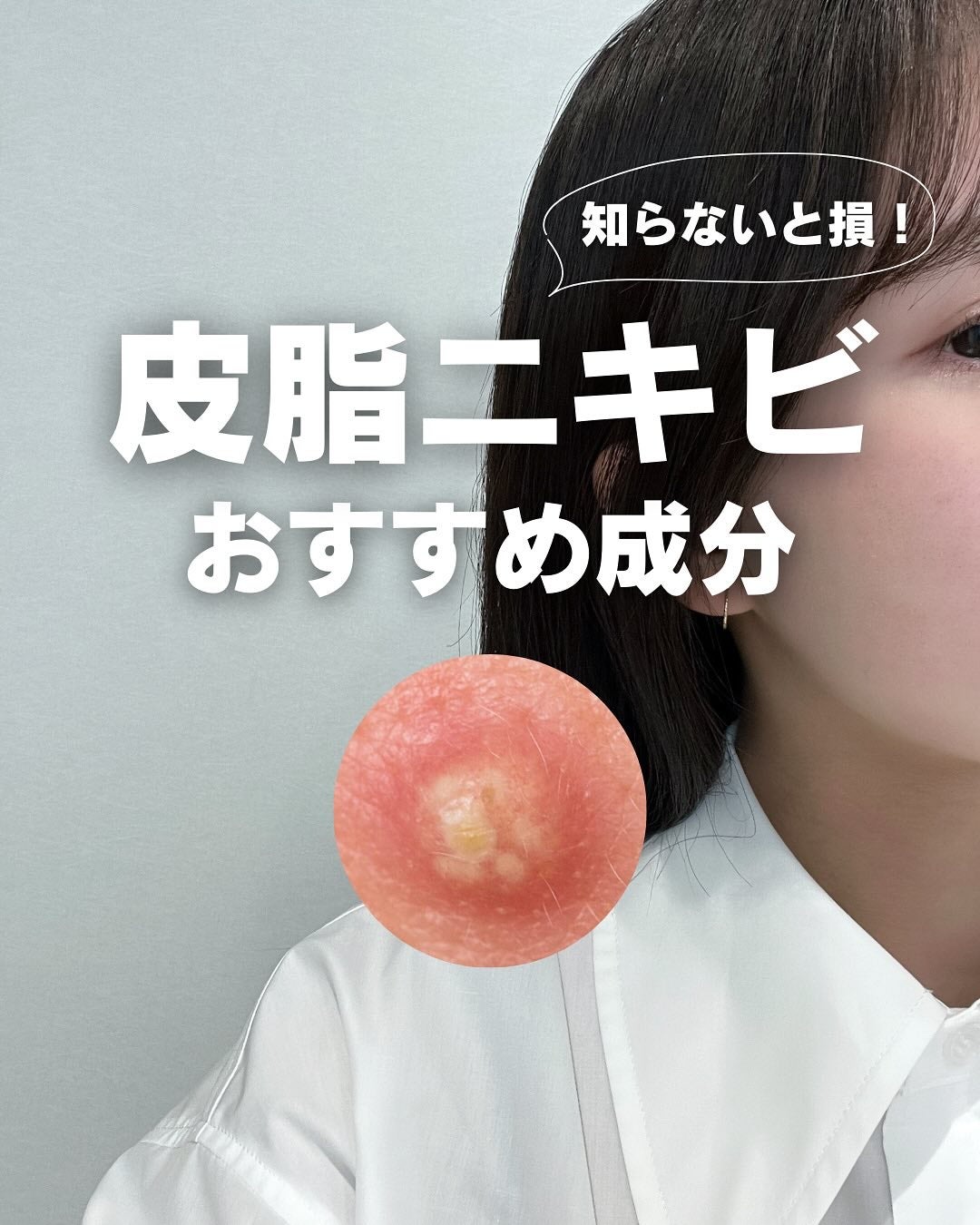 白湯(サユ) | ニキビと戦うOL🤍 on LIPS 「.白湯です!皮脂ニキビに悩む人一旦集合💫そもそも皮脂ニキビって..」(1枚目)