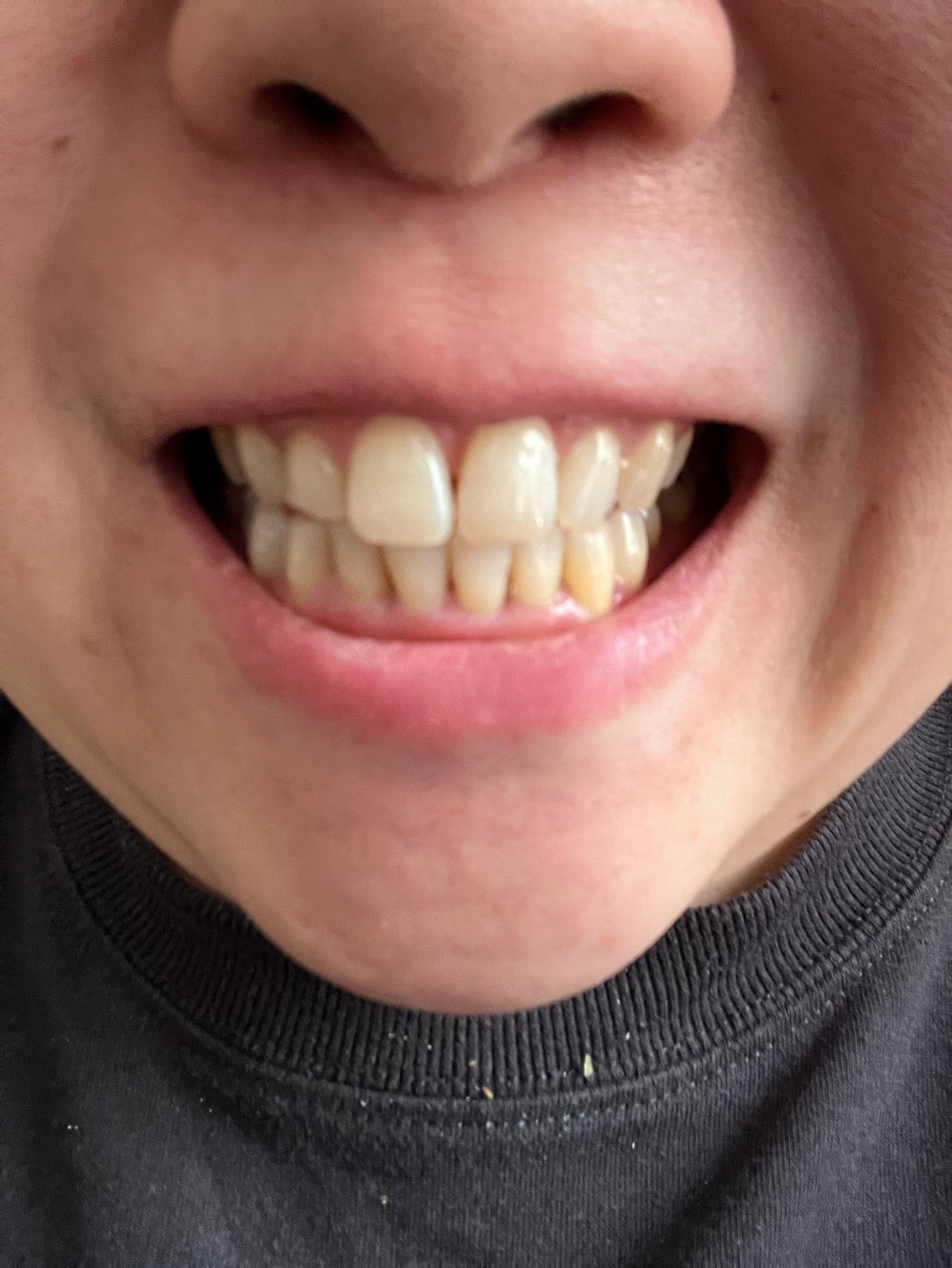 ハニックDC アクア/ハニック・ホワイトラボ/その他オーラルケアを使ったクチコミ(4枚目)