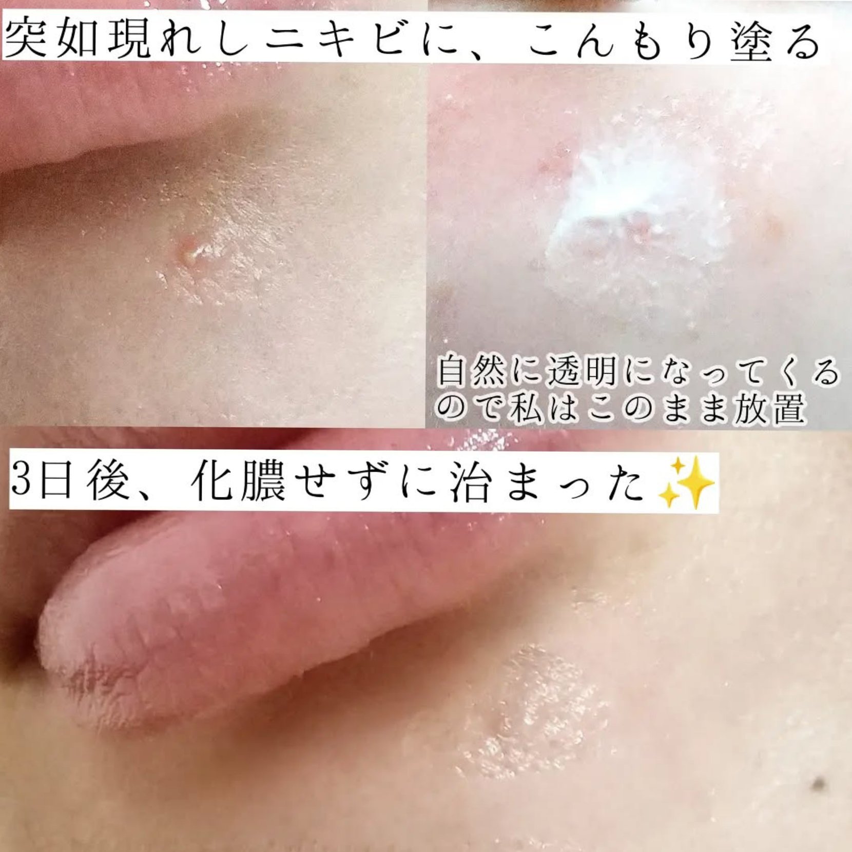 アクネキュアクリーム(医薬品)/IHADA/その他を使ったクチコミ（3枚目）