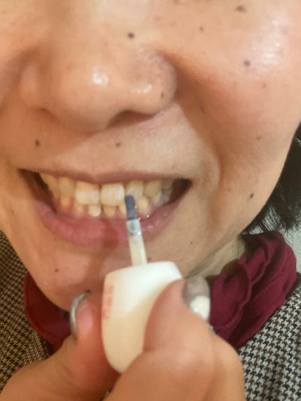 ハニックDC スノー/ハニック・ホワイトラボ/その他オーラルケアを使ったクチコミ(9枚目)