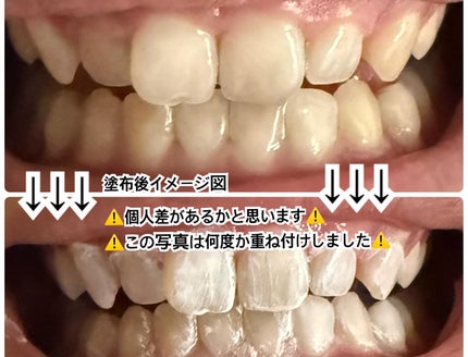 ホワイトクイーン/ハニック・ホワイトラボ/その他オーラルケアを使ったクチコミ(7枚目)