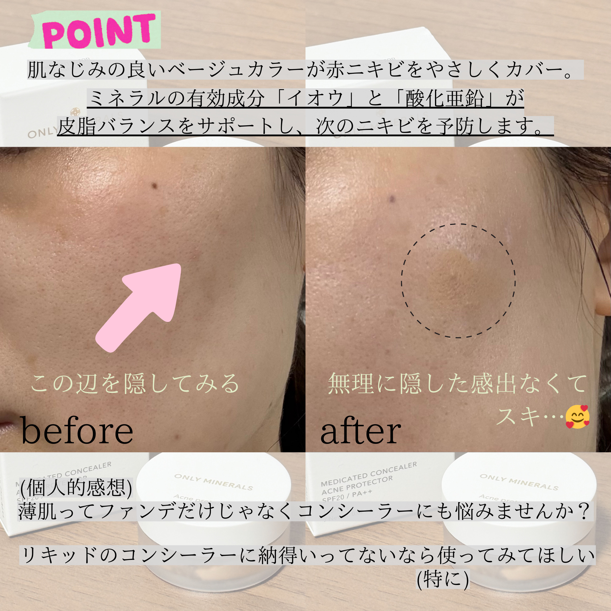 薬用コンシーラー アクネプロテクター/ONLY MINERALS/パウダーコンシーラーを使ったクチコミ（3枚目）