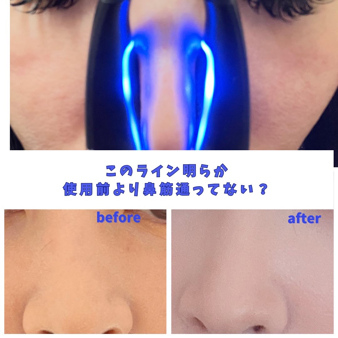 Qnose/NIPLUX/美顔器・マッサージを使ったクチコミ（1枚目）