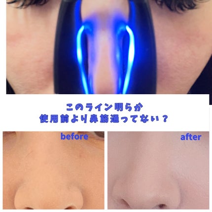 Qnose/NIPLUX/美顔器・マッサージを使ったクチコミ(1枚目)