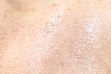 RXザ・アルファアルブチン2 ニキビ跡ケアセラム/COSRX/美容液を使ったクチコミ(6枚目)