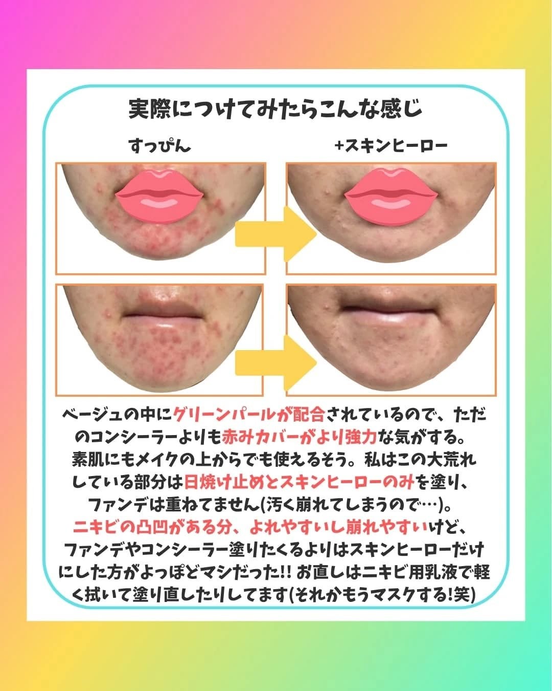 薬用スポットシーラークリーム/スキンヒーロー/クリームコンシーラーを使ったクチコミ(4枚目)