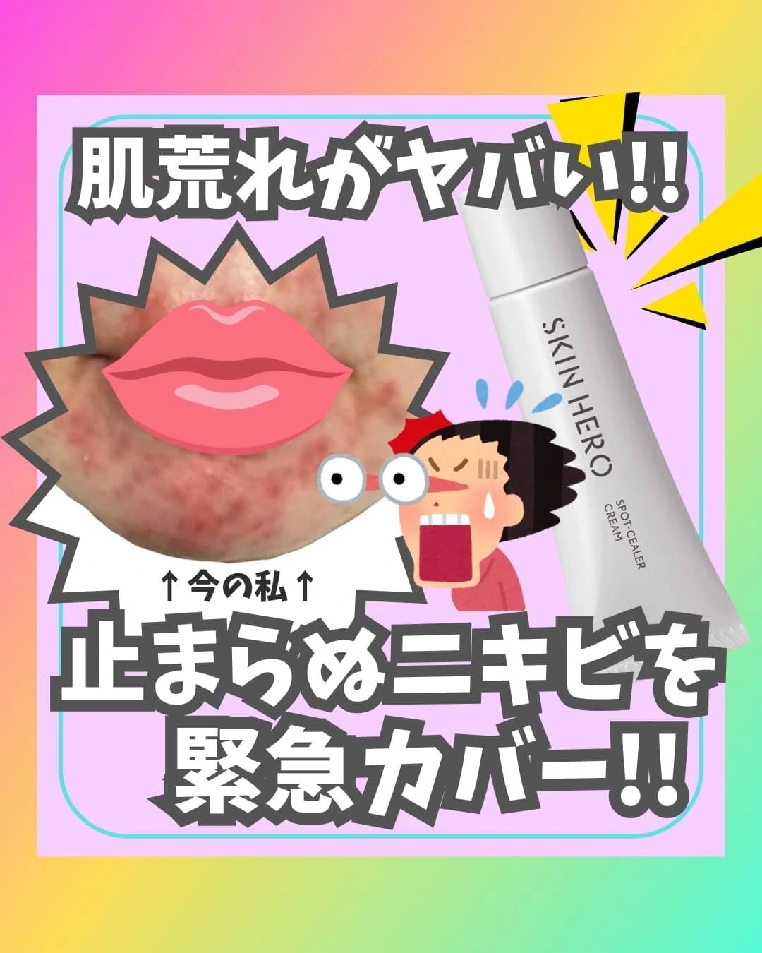 スキンヒーロー 薬用スポットシーラークリームのクチコミ「ニキビ肌・毛穴肌のリアルなコスメレビューを発信しているNARIです🌸

最近なかなか頻繁に更新.....」（1枚目）