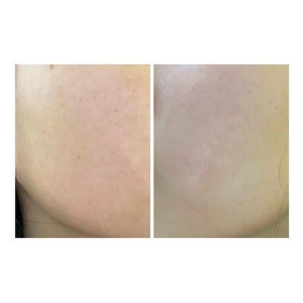 ぽむ on LIPS 「2023.9.13皮膚科に受診 エピデュオとヘパリン処方1枚目..」(4枚目)