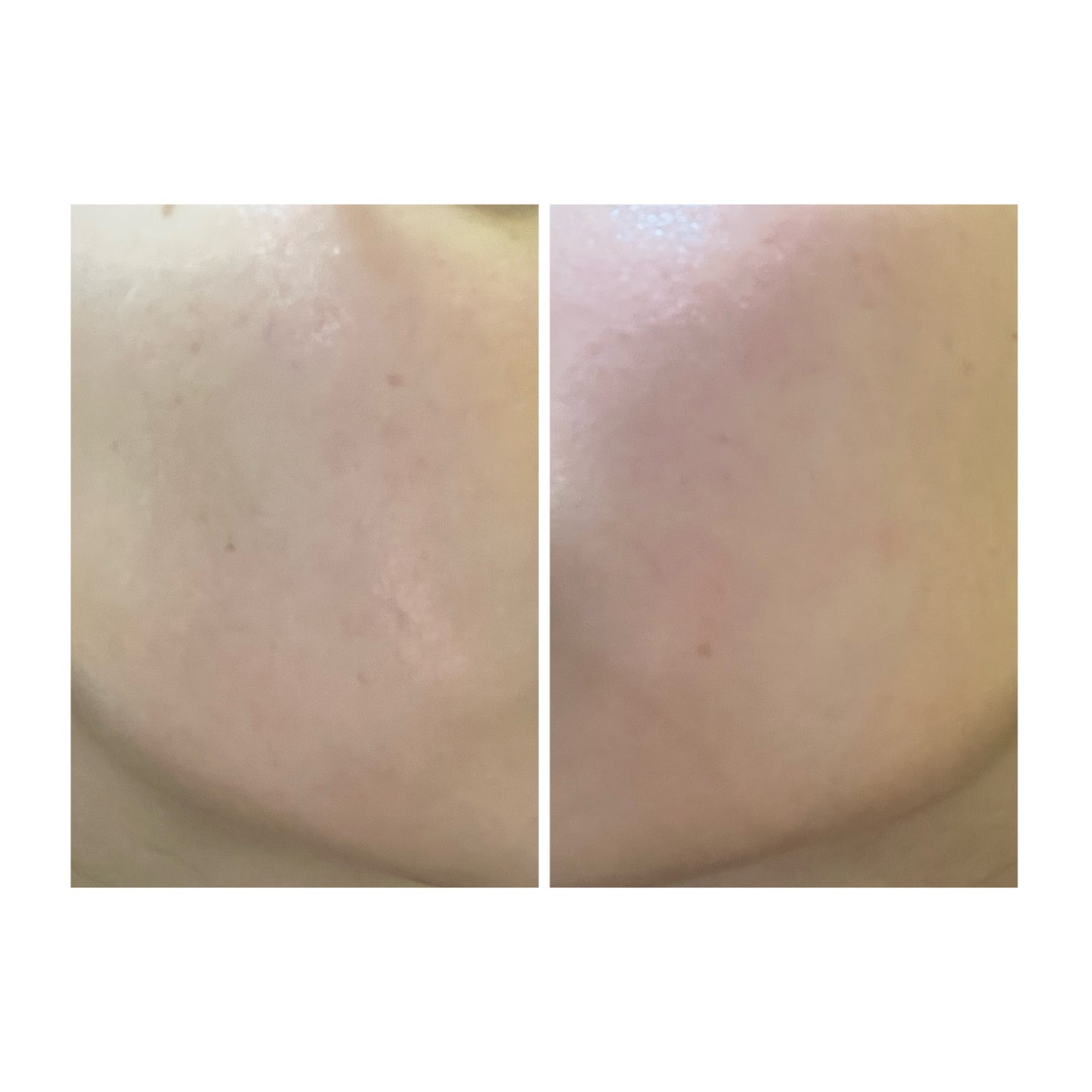 ぽむ on LIPS 「2023.9.13皮膚科に受診 エピデュオとヘパリン処方1枚目..」(3枚目)