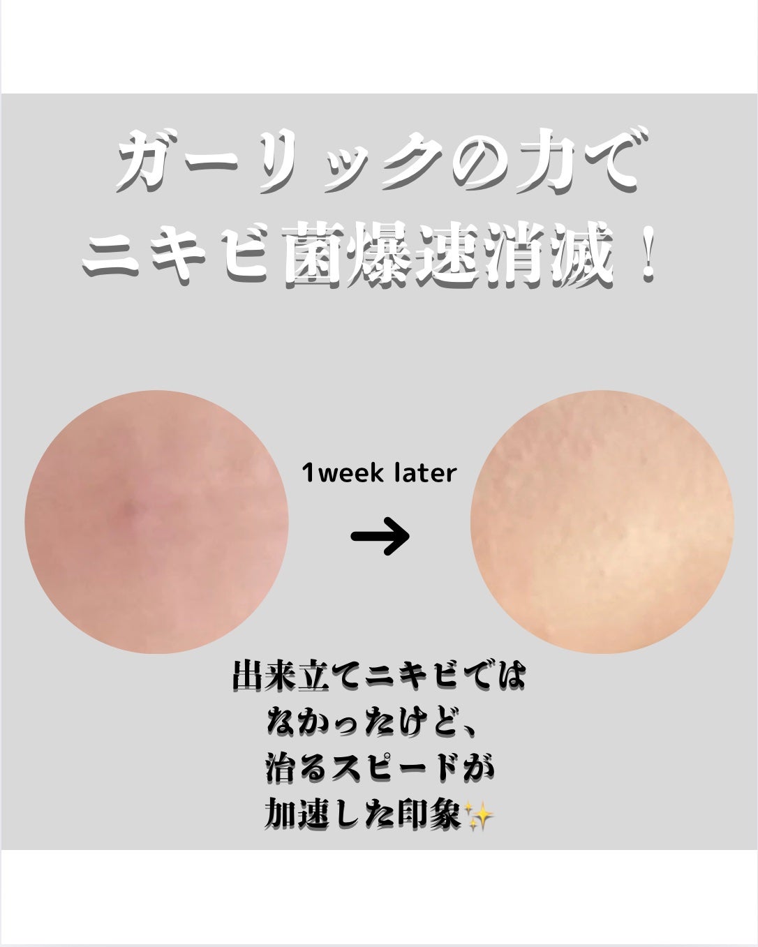 AZケア クレンジングオイル/VT/オイルクレンジングを使ったクチコミ(6枚目)