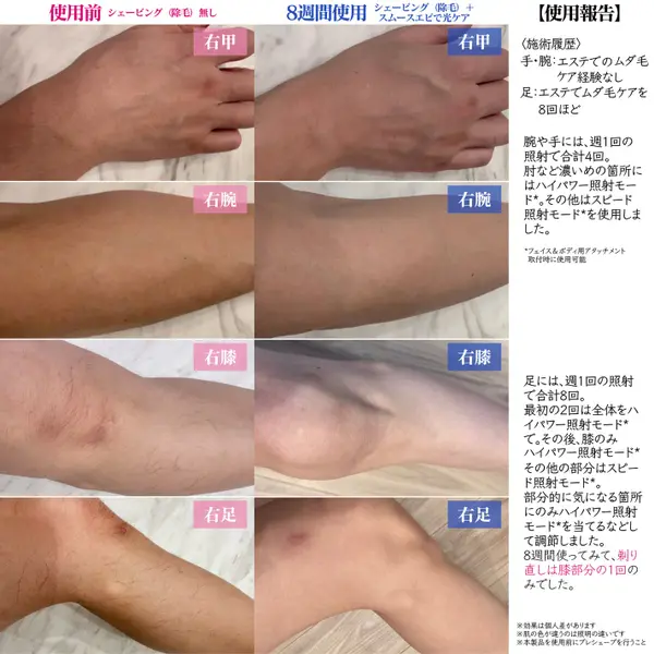 パナソニックの家庭用光美容器にムーブメントの予感!『実際どう?家でムダ毛ケア』の画像