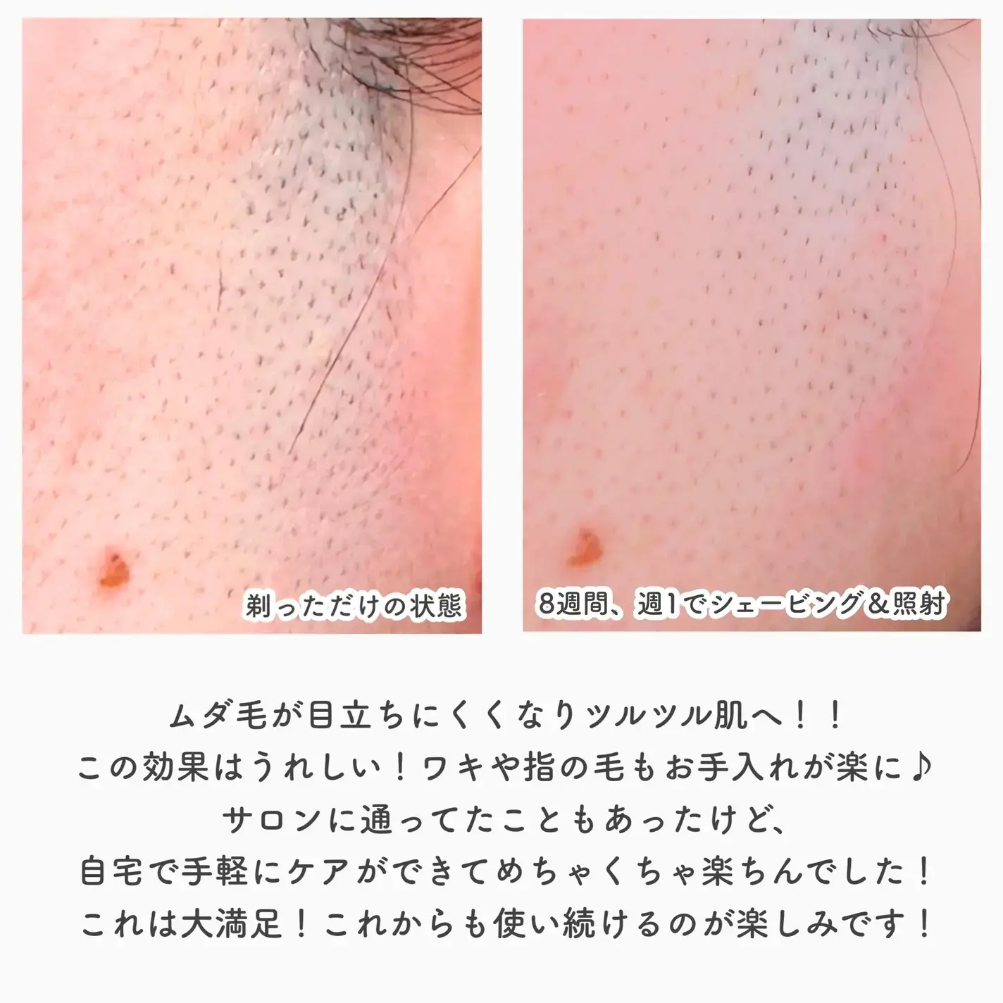 パナソニックの家庭用光美容器にムーブメントの予感!『実際どう?家でムダ毛ケア』の画像