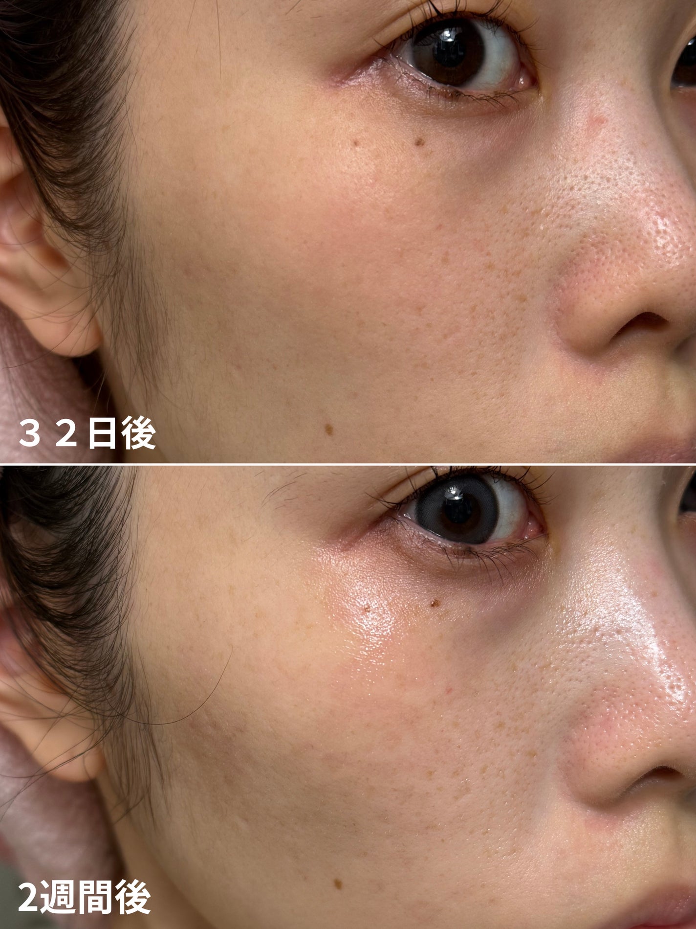 春風ゆうか🧸フォロバ100 on LIPS 「【そばかすとりピコスポット取り放題32日経過】記録✍️背術から..」(2枚目)