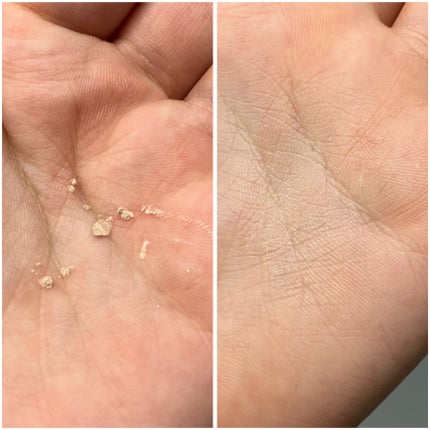 薬用コンシーラー アクネプロテクター/ONLY MINERALS/パウダーコンシーラーを使ったクチコミ(5枚目)