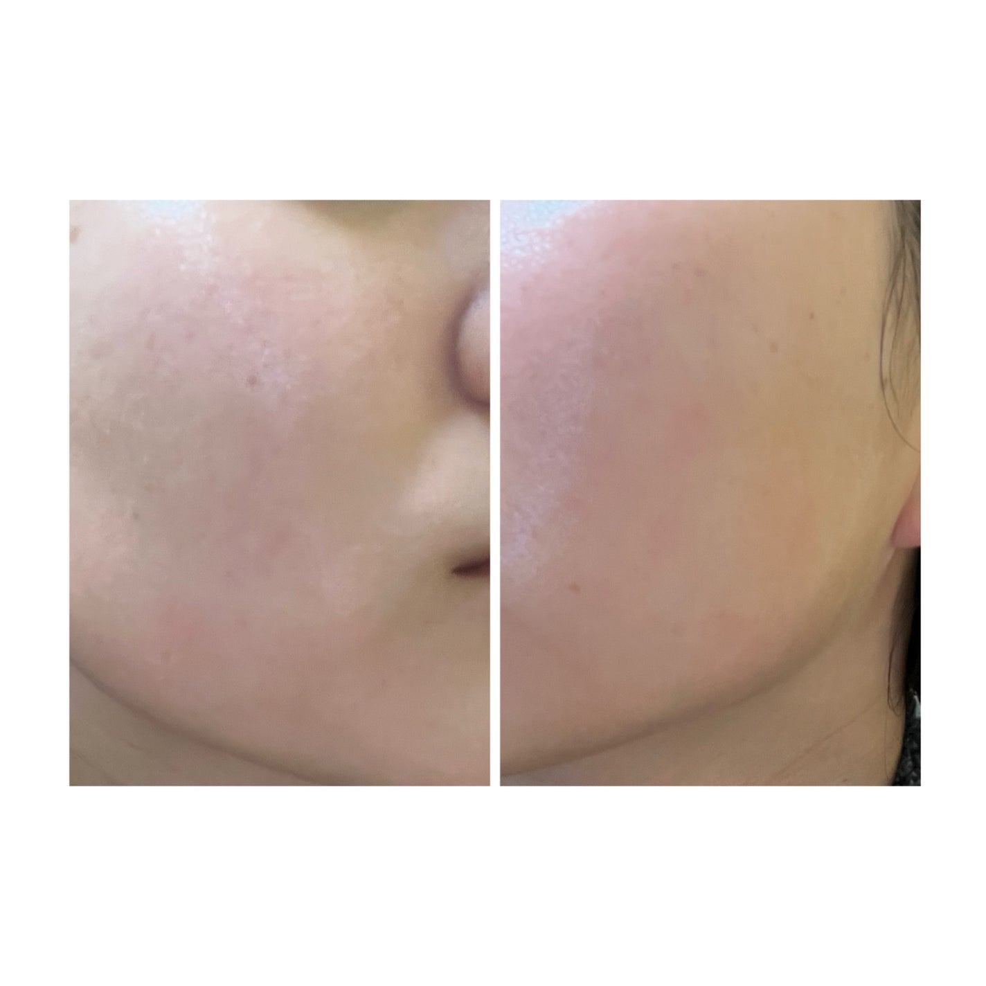 ぽむ on LIPS 「2023.9.13皮膚科に受診 エピデュオとヘパリン処方1枚目..」(4枚目)