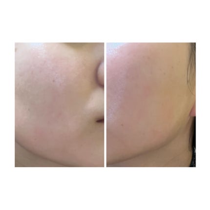 ぽむ on LIPS 「2023.9.13皮膚科に受診 エピデュオとヘパリン処方1枚目..」(4枚目)