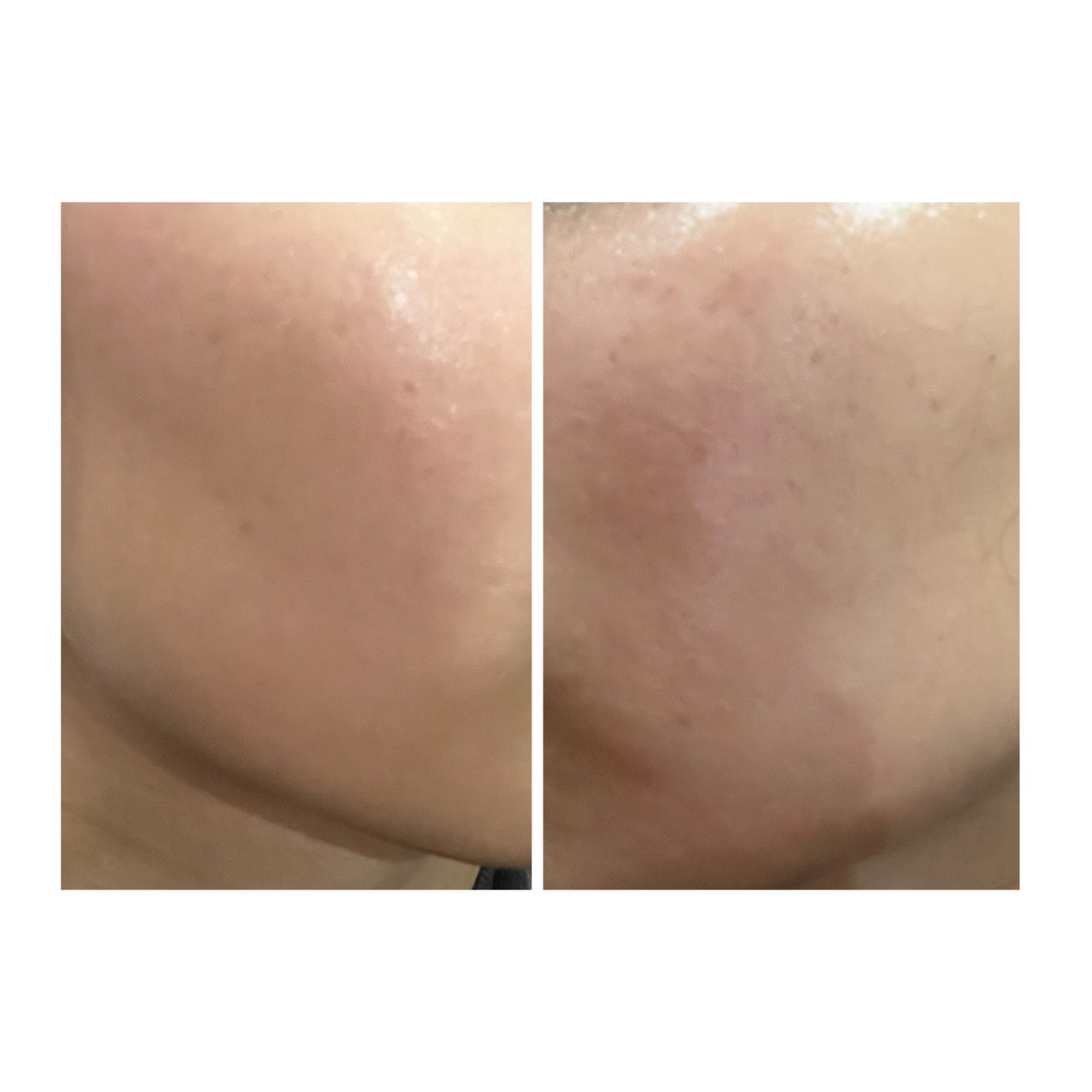 ぽむ on LIPS 「2023.9.13皮膚科に受診 エピデュオとヘパリン処方1枚目..」(1枚目)