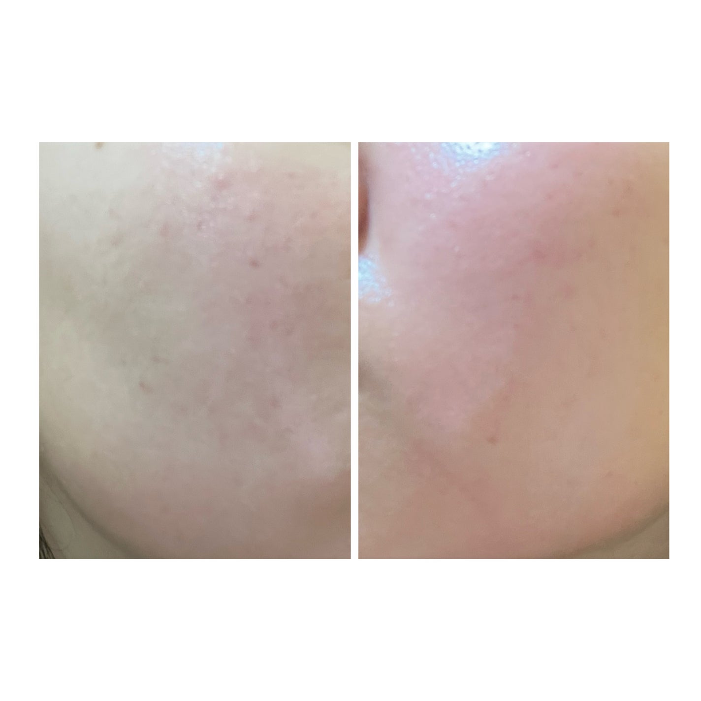 ぽむ on LIPS 「2023.9.13皮膚科に受診 エピデュオとヘパリン処方1枚目..」(2枚目)