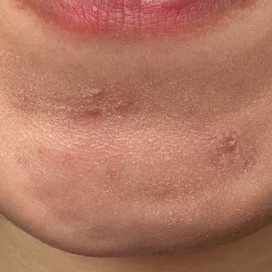 薬用コンシーラー アクネプロテクター/ONLY MINERALS/パウダーコンシーラーを使ったクチコミ(4枚目)