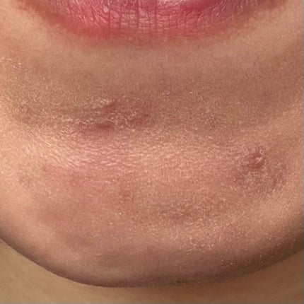 薬用コンシーラー アクネプロテクター/ONLY MINERALS/パウダーコンシーラーを使ったクチコミ(4枚目)