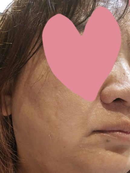 クリアラスト フェイスパウダー N 薬用オークル/クリアラスト/プレストパウダーを使ったクチコミ(3枚目)