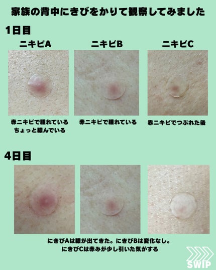 プロCICA クリアスポットパッチ/VT/その他スキンケアを使ったクチコミ(5枚目)