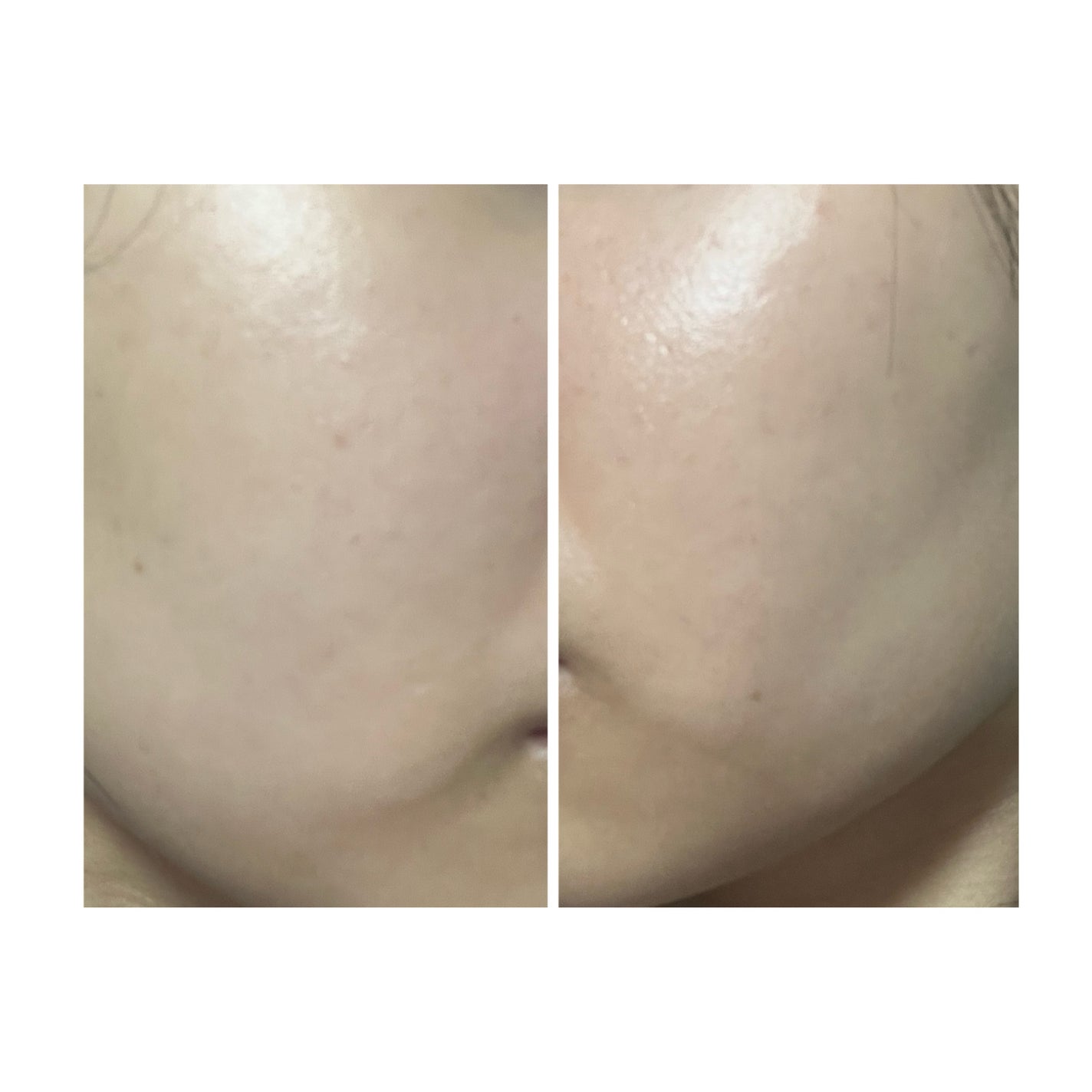 ぽむ on LIPS 「2023.9.13皮膚科に受診 エピデュオとヘパリン処方1枚目..」(3枚目)