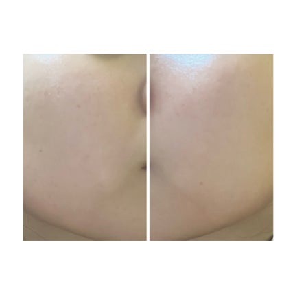 ぽむ on LIPS 「2023.9.13皮膚科に受診 エピデュオとヘパリン処方1枚目..」(4枚目)