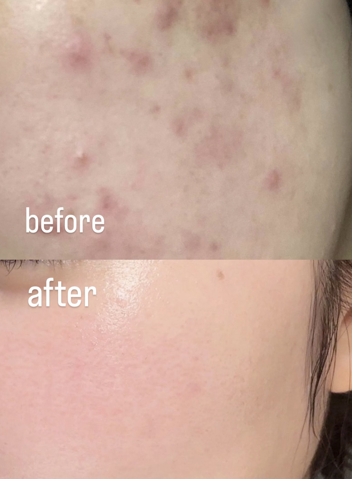  マキロン アクネージュ メディカルクリーム	(医薬品）	/マキロン/その他を使ったクチコミ（3枚目）