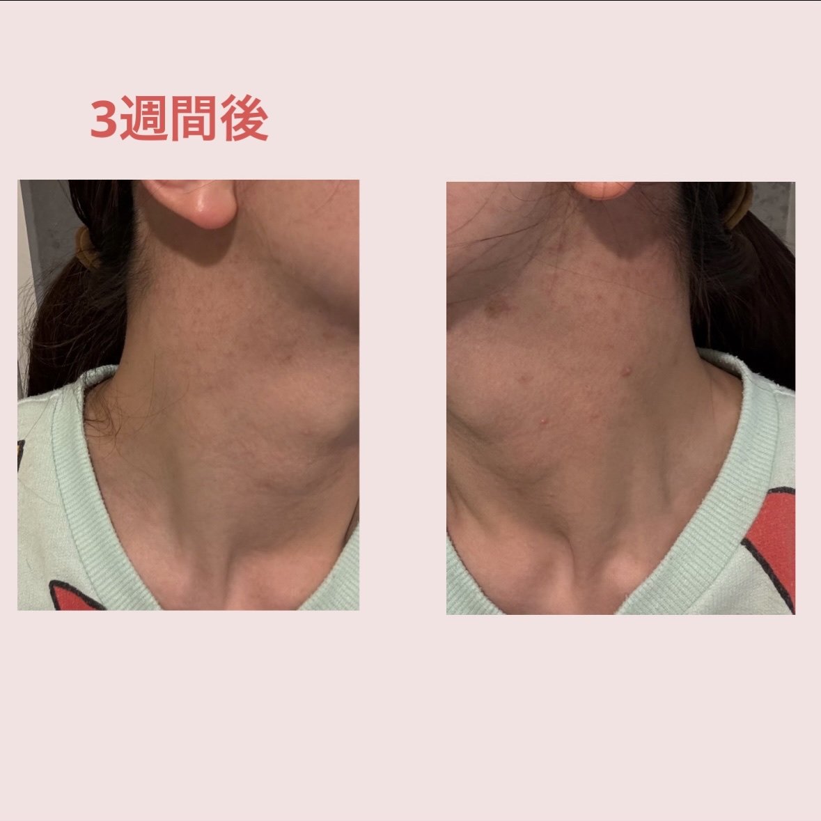 桂枝茯苓丸(医薬品)/ツムラ/その他を使ったクチコミ（3枚目）