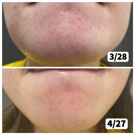 アゼライン酸15 インテンスカーミングセラム/Anua/美容液を使ったクチコミ(5枚目)