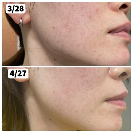 アゼライン酸15 インテンスカーミングセラム/Anua/美容液を使ったクチコミ(4枚目)