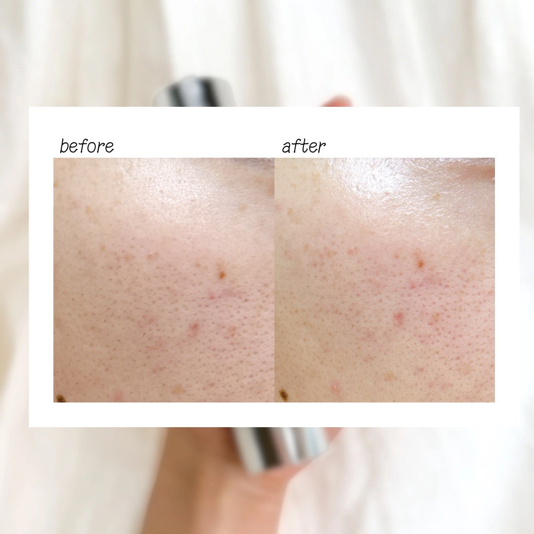 リードルショット300/VT/美容液を使ったクチコミ(5枚目)