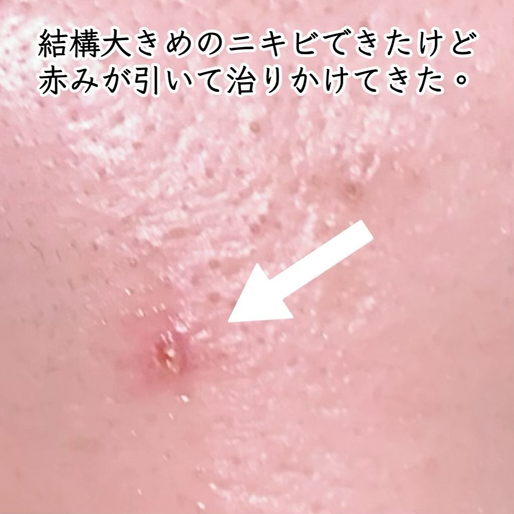 AZアゼライン酸15セラム/コスデバハ/美容液を使ったクチコミ(7枚目)